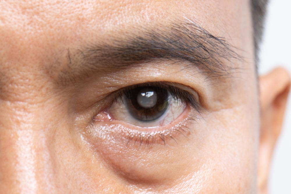 What is a cataract? Image of an upclose man's eye with a gray tint in the eye where the cataract is.