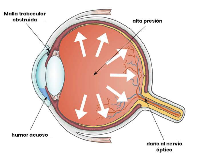 Diagram of glaucoma causes