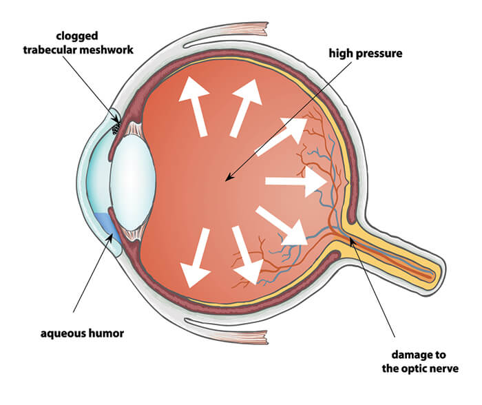 glaucoma laser surgery
