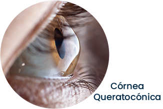 Keratoconic Cornea