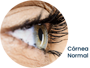 Normal Cornea