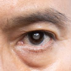 What is a cataract? Image of an upclose man's eye with a gray tint in the eye where the cataract is.